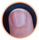 Ongle de 3 millimètres Ongle de 3 millimètres